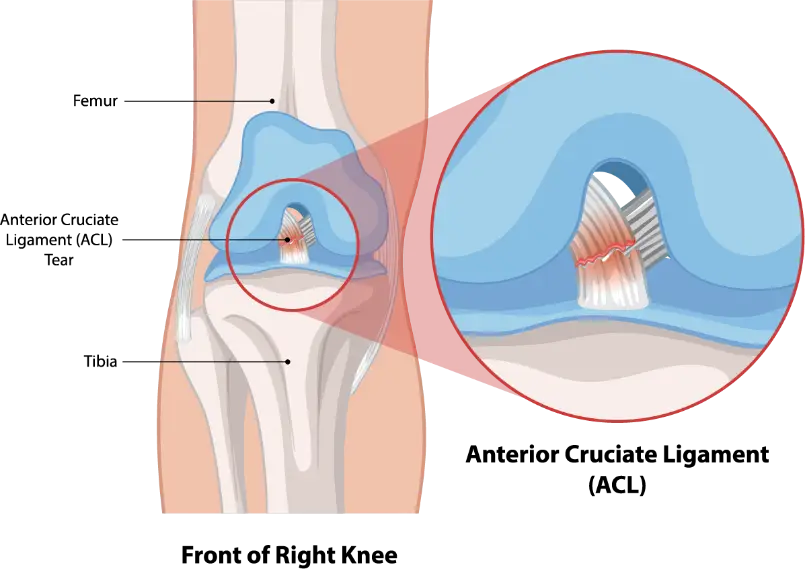 acl tear