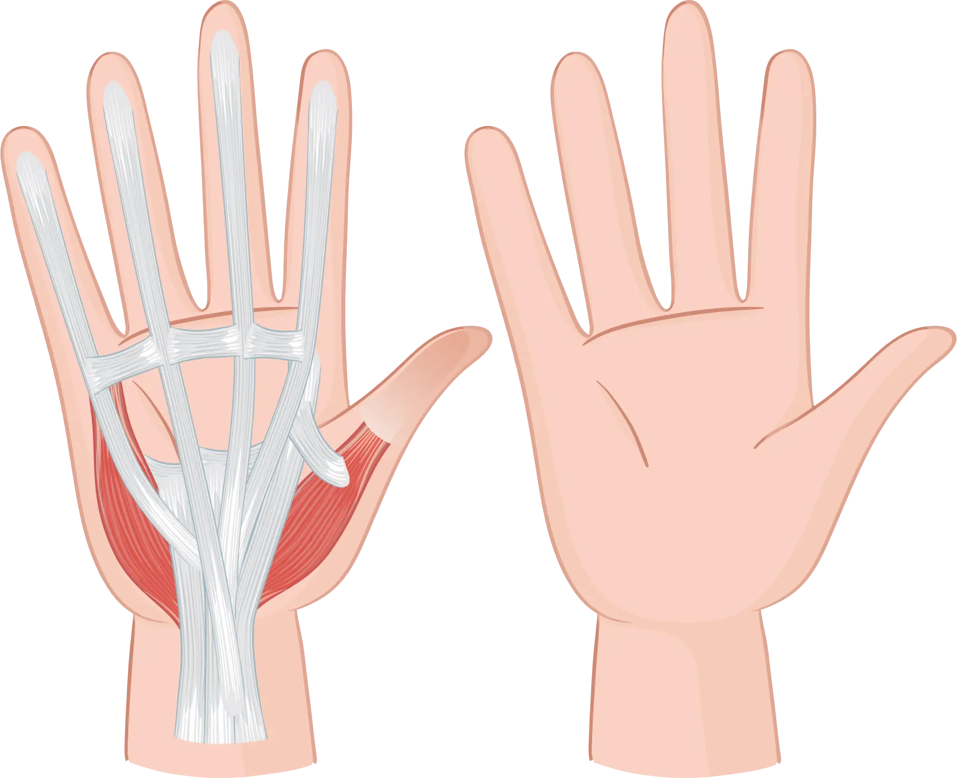 carpal tunnel syndrome