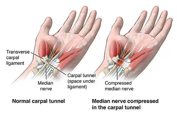 median nerve compression
