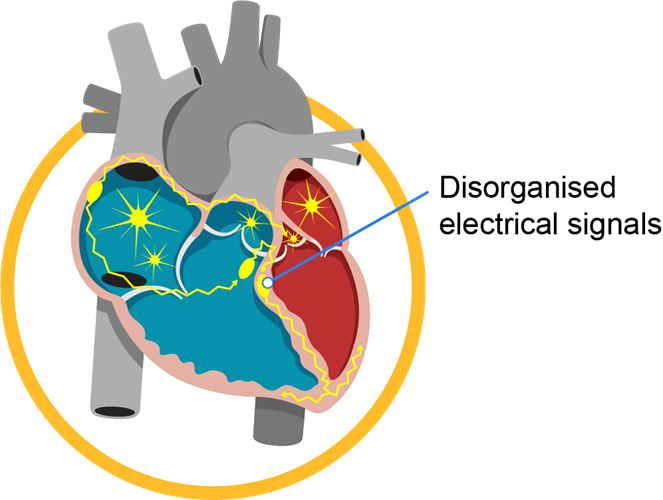 abnormal_heart_rhythm_infobanner_1