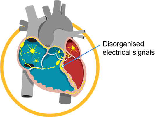 abnormal_heart_rhythm_infobanner_1