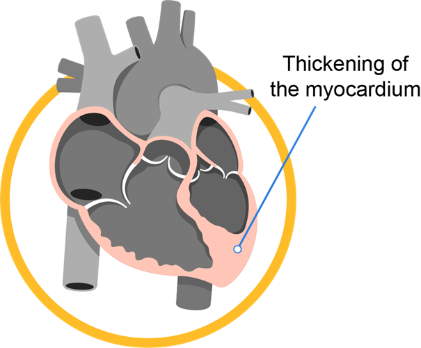 cardiomyopathy_infobanner_1