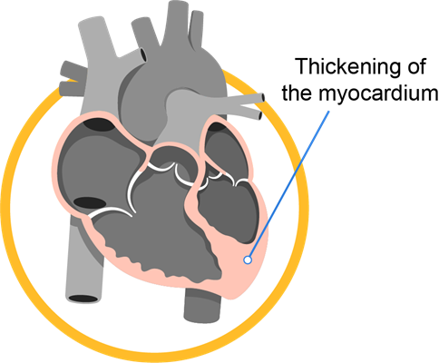 cardiomyopathy_infobanner_1