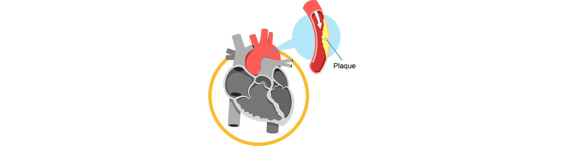 plaque build-up in coronary arteries
