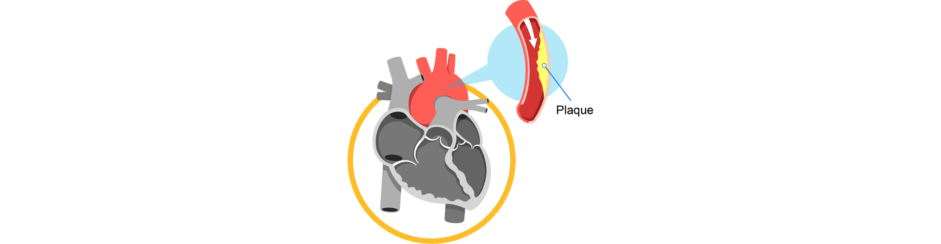 coronary_artery_disease_banner_1
