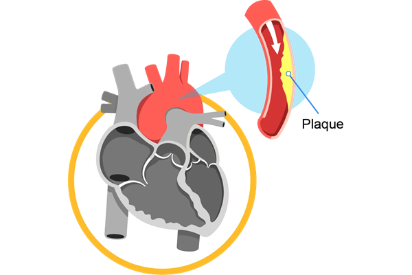 coronary_artery_disease_banner_mobile