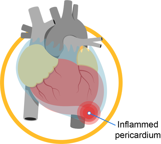 pericardial_disease_infobanner_1