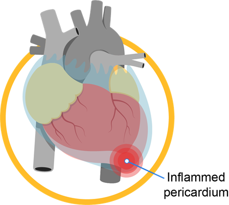 pericardial_disease_infobanner_1