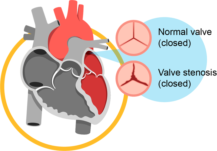 valvular_heart_disease_infobanner_1