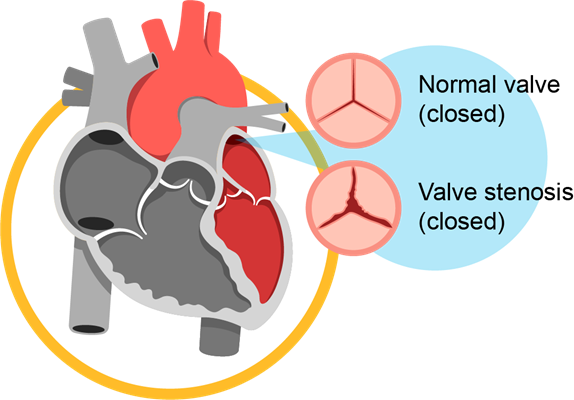 valvular_heart_disease_infobanner_1