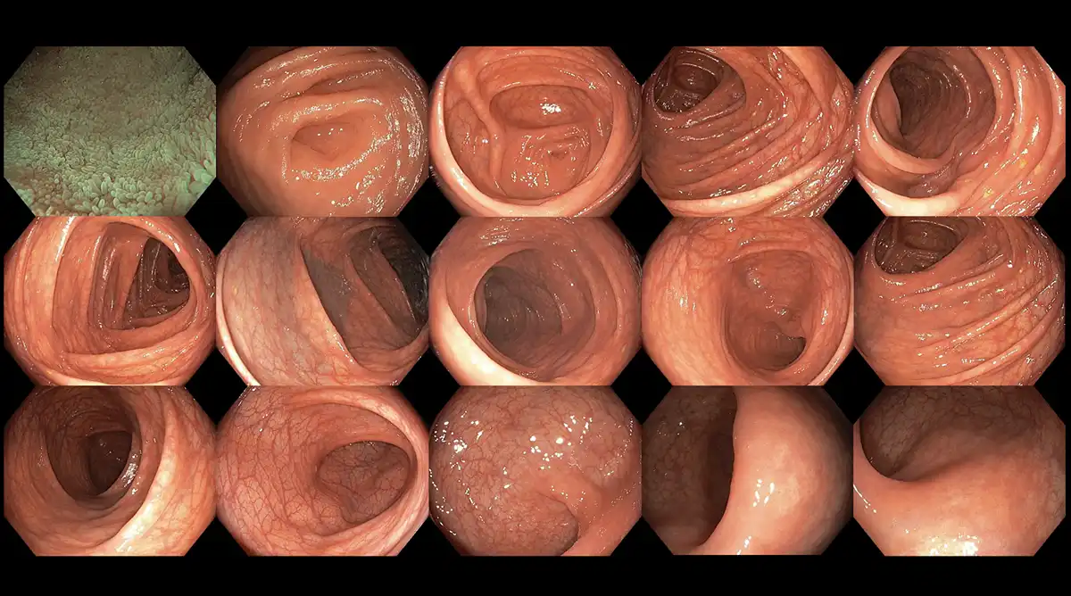 An example of an excellent bowel preparation during colonoscopy image