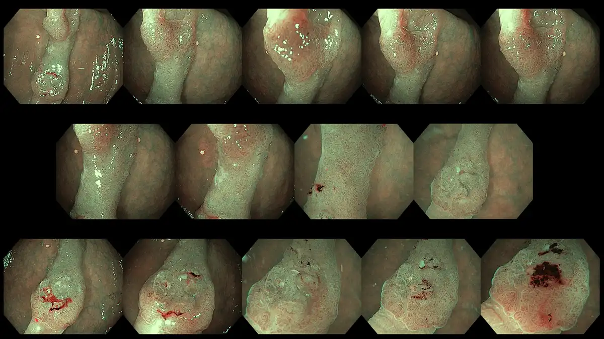 Another example of characterization of an intermediately sized polyp with deep invasion which is not amenable for endoscopic removal image