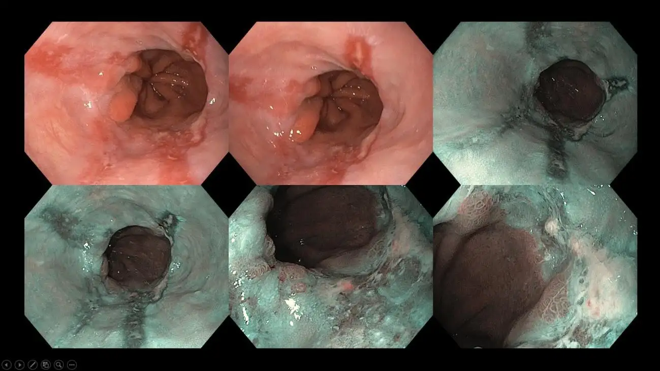 BEYOND THE BURN UNDERSTANDING ACID REFLUX-10