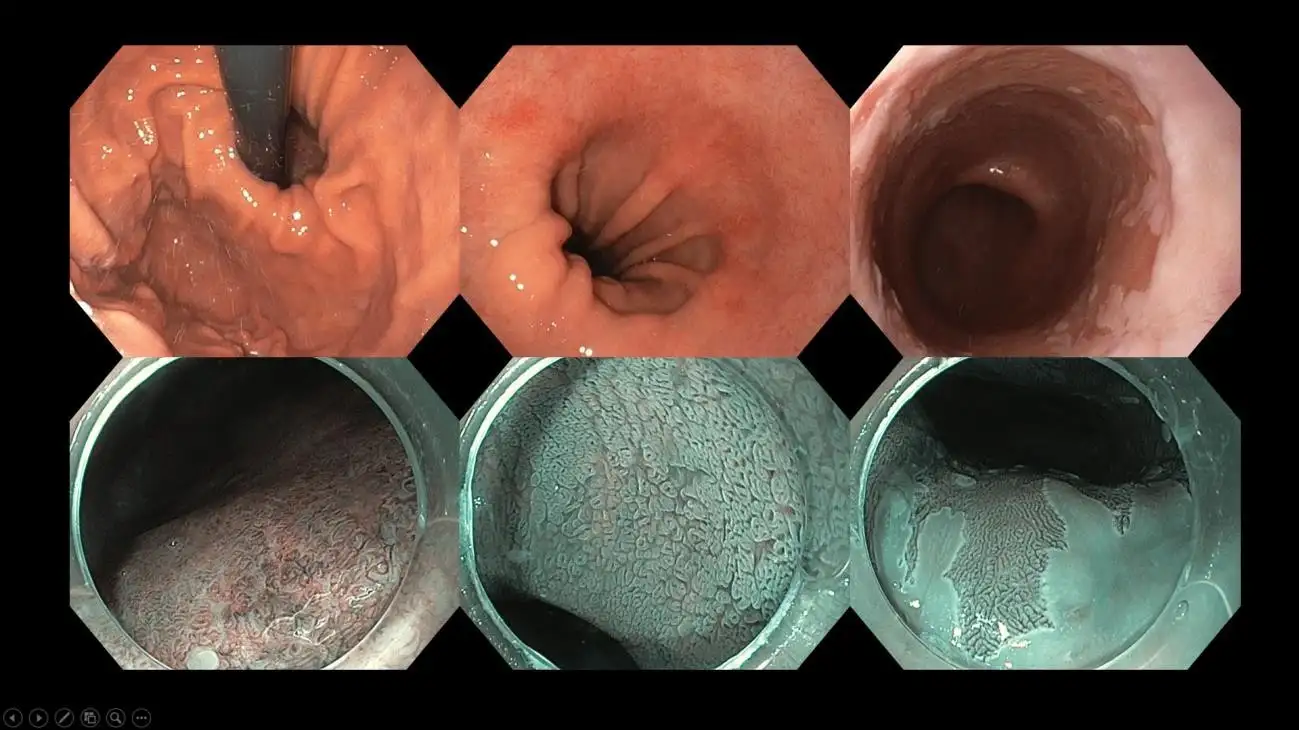 BEYOND THE BURN UNDERSTANDING ACID REFLUX-12