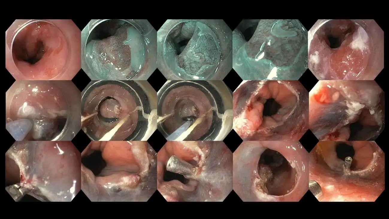 BEYOND THE BURN UNDERSTANDING ACID REFLUX-13