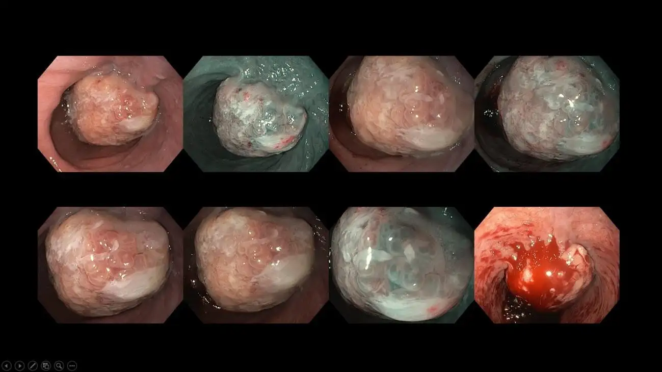 BEYOND THE BURN UNDERSTANDING ACID REFLUX-14