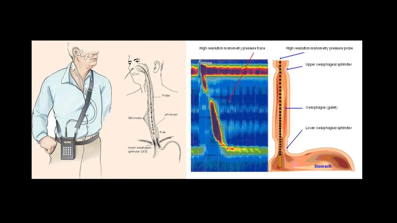 BEYOND THE BURN UNDERSTANDING ACID REFLUX-15