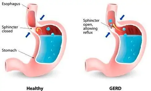 BEYOND THE BURN UNDERSTANDING ACID REFLUX-2