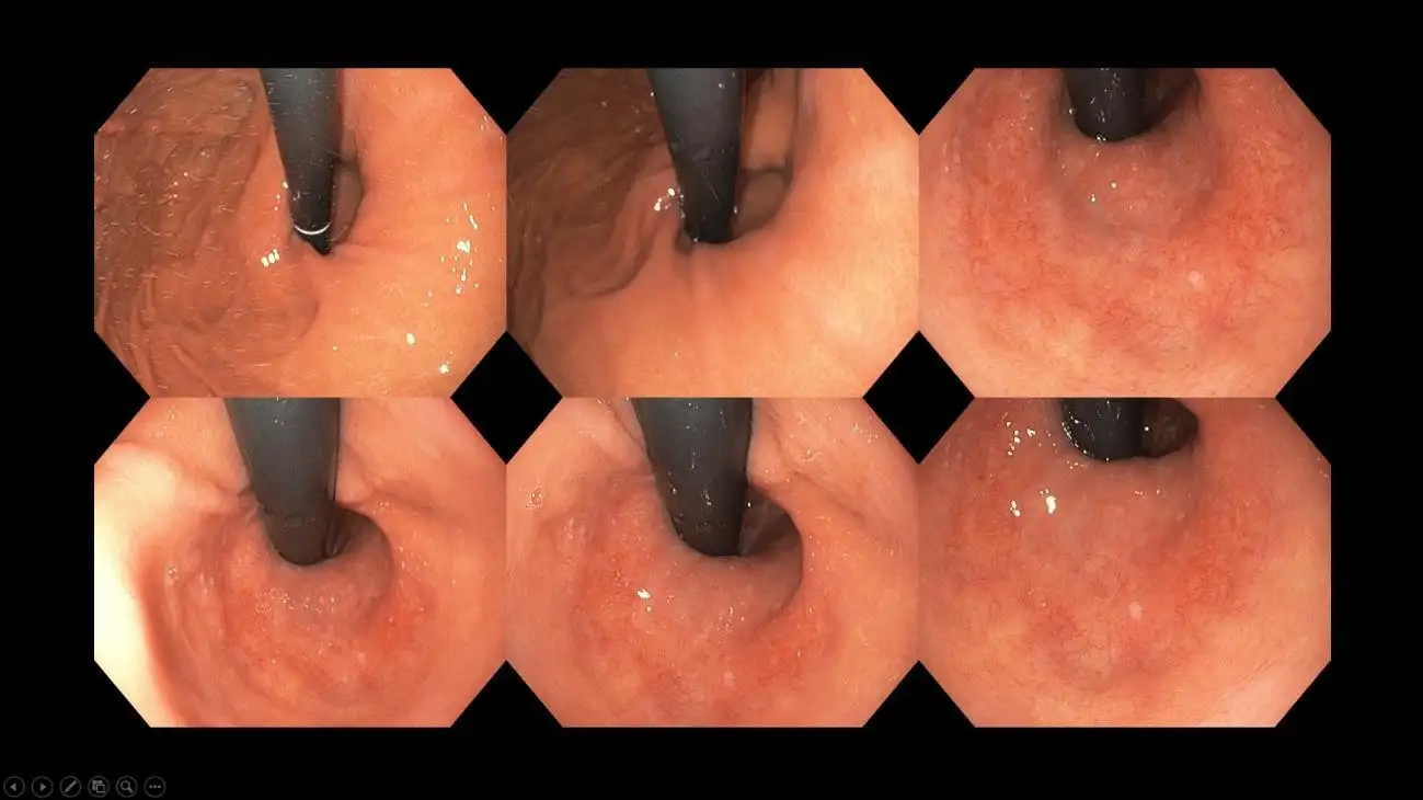 BEYOND THE BURN UNDERSTANDING ACID REFLUX-9