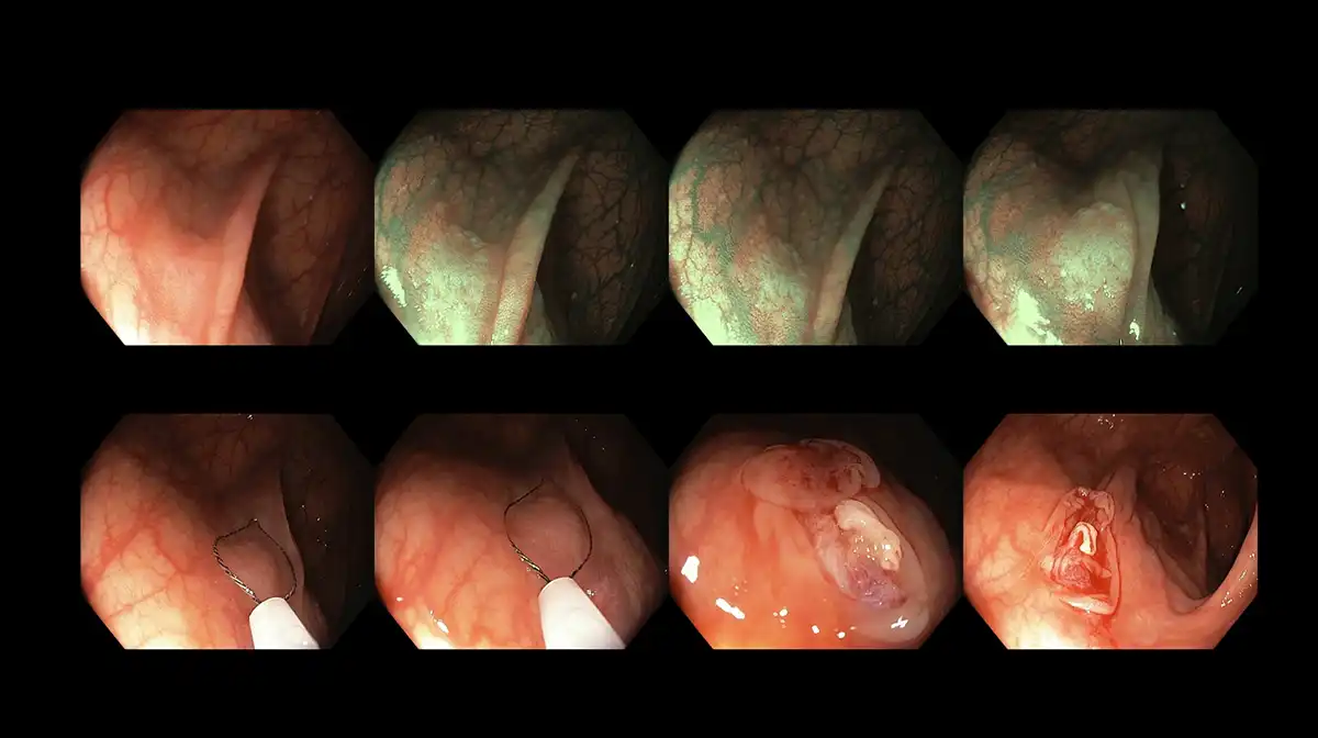 Conventional cold snare polypectomy to remove a subtle colonic polyp image
