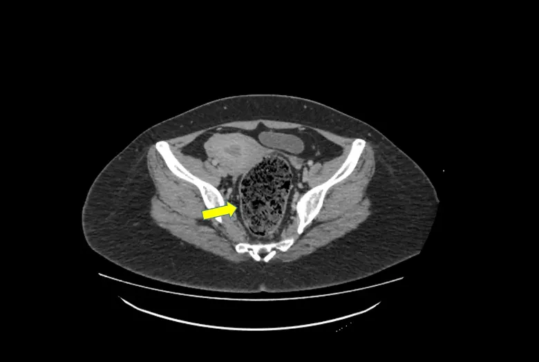 CT scan of the abdomen and pelvis revealed