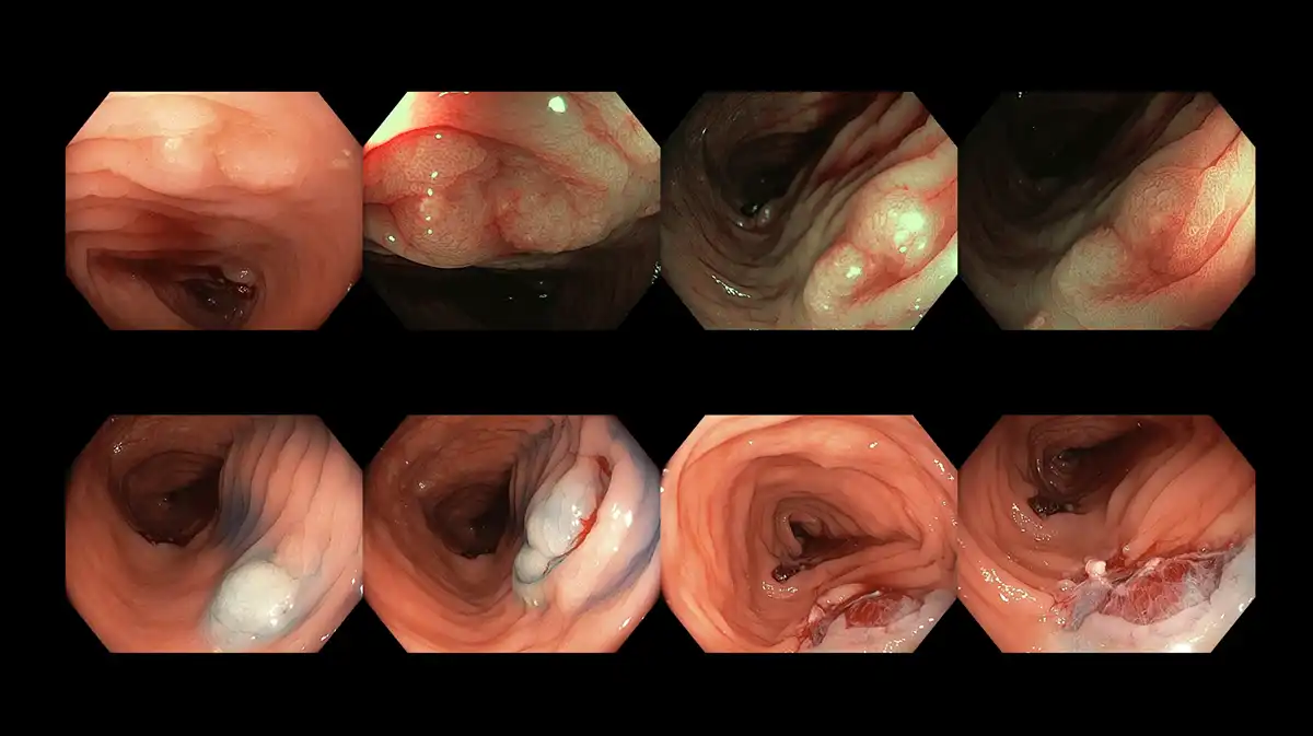 Piecemeal cold snare endoscopic mucosal resection to completely excise a polyp detected during colonoscopy image
