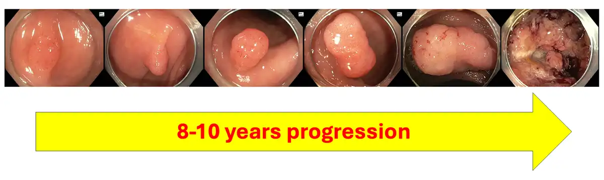 Progression interval of colorectal polyps to advanced cancers image