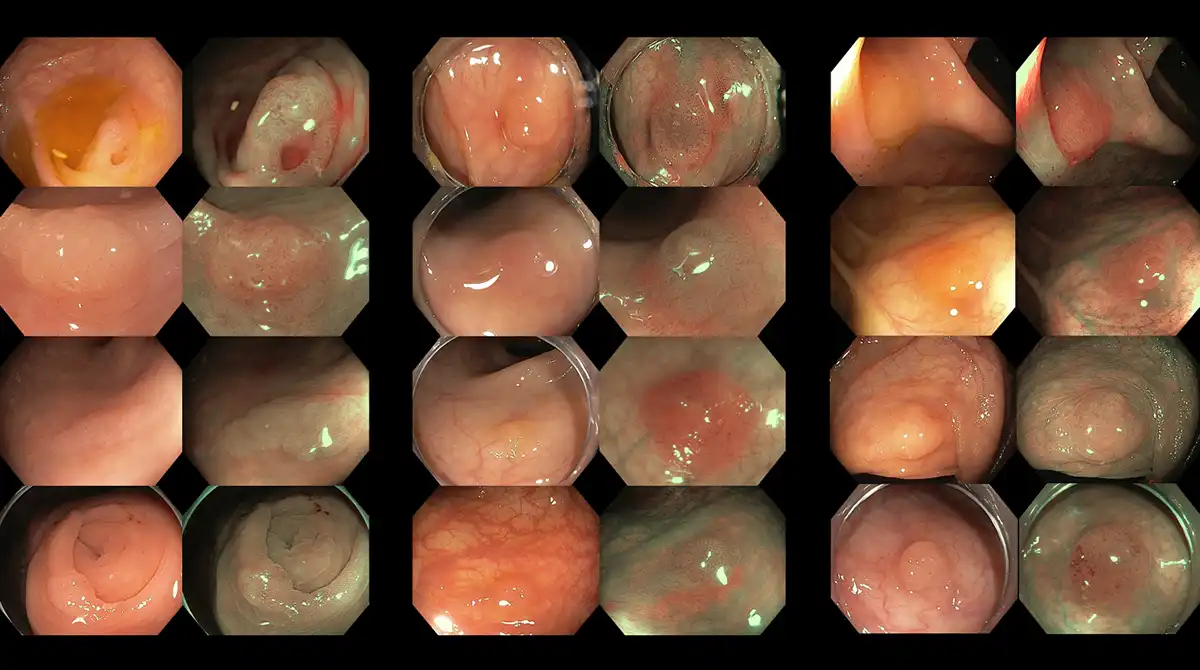Subtle colorectal polyps detected image