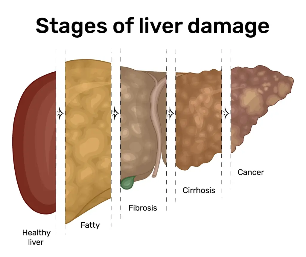 UNDERSTANDING FATTY LIVER DISEASE11