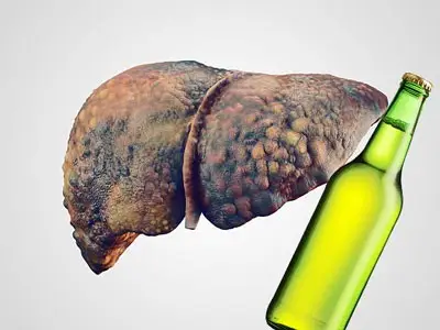 UNDERSTANDING FATTY LIVER DISEASE4