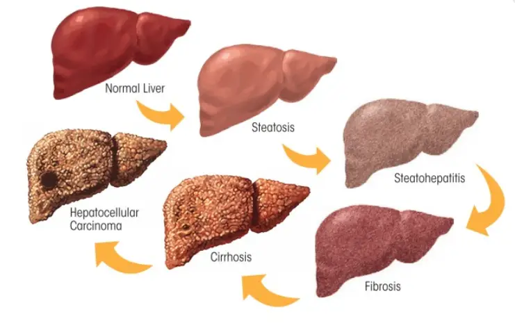 UNDERSTANDING FATTY LIVER DISEASE5