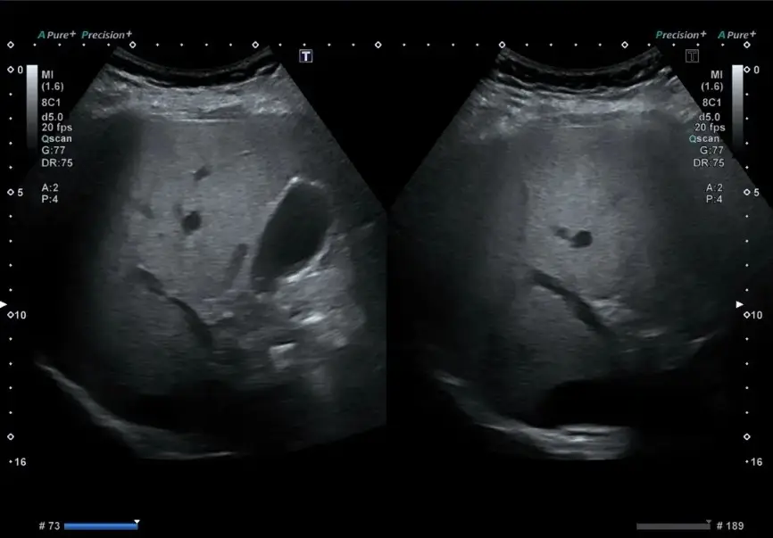 UNDERSTANDING FATTY LIVER DISEASE9